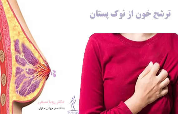 ترشح خون از نوک پستان