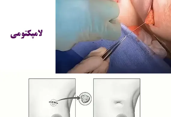 لامپکتومی