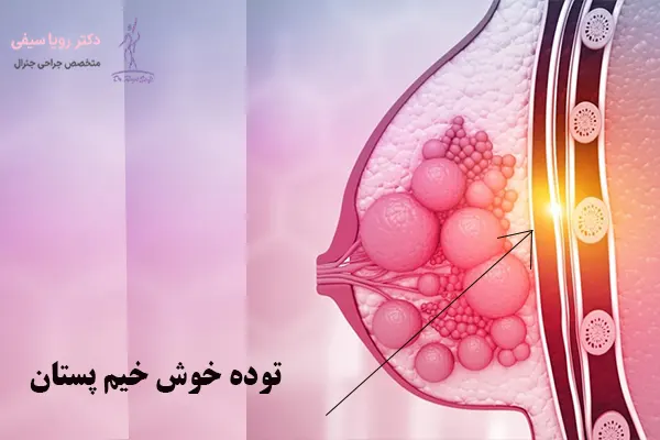 توده خوش خیم پستان