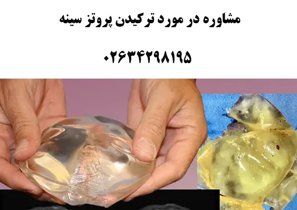 مشاوره ترکیدن پروتز سینه